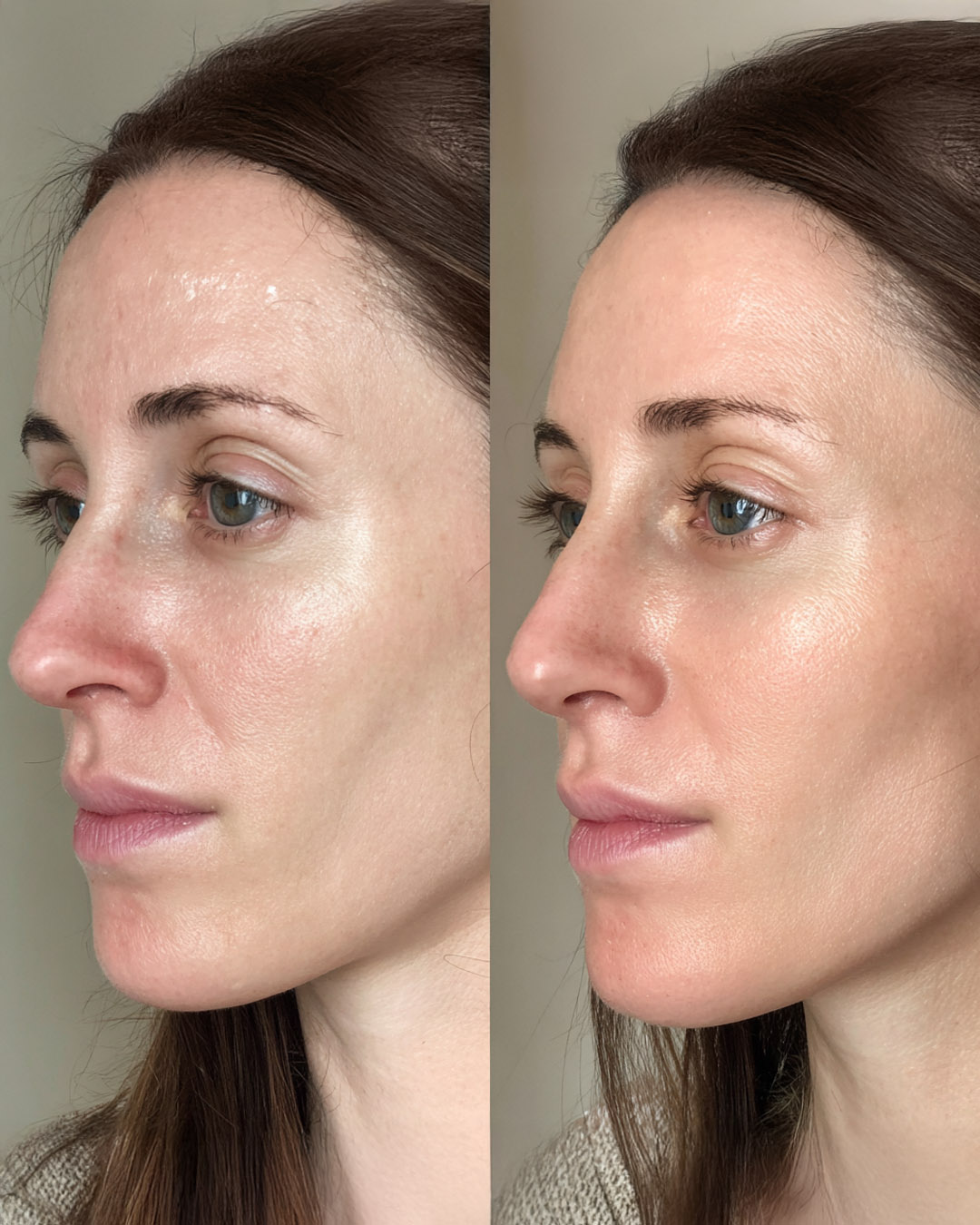 A before and after image showing the benefits of using hyaluronic acid
